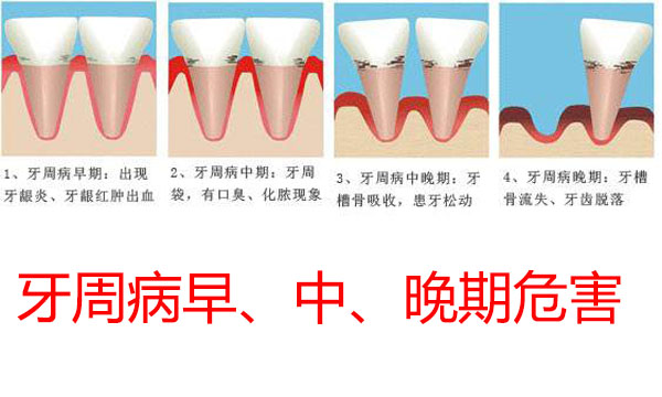 牙周病经久不愈要注意了,你可能是得了糖尿病!