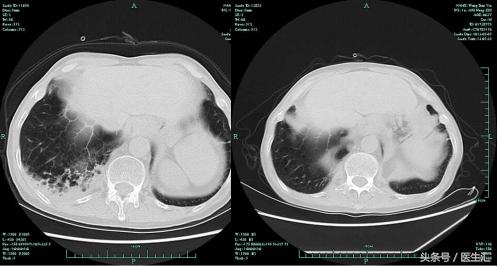 社区获得性肺炎非重症dr报告单,copd慢性阻塞性肺炎案例分析