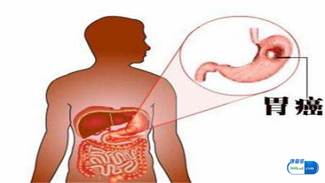 胃复春能治胃癌吗,胃癌前病变中成药