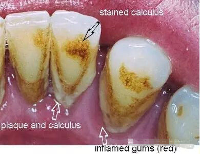 20年不洗牙,20年不刷牙还能刷白吗