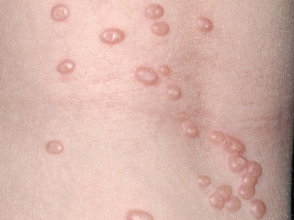 宝宝皮肤常见“痘痘”,看图学习,快点收藏起来!