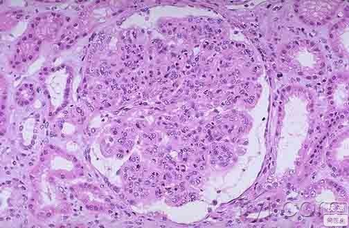 丹毒的症状和发病原因是什么,丹毒的症状与治疗方法