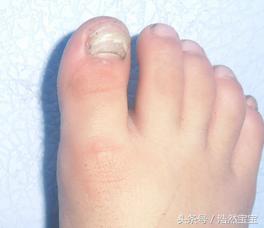 发现孩子指甲有问题日常建议,家长注意孩子手指甲