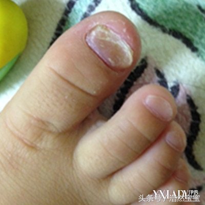 发现孩子指甲有问题日常建议,家长注意孩子手指甲