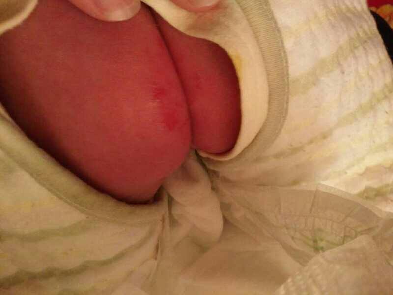 新手怎么护理宝宝红屁股,宝宝红屁股妈妈饮食注意