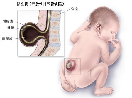 脊柱裂和脊柱有缝隙有什么区别,脊柱裂是骨骼病症吗