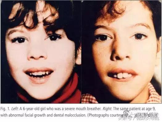 用嘴呼吸的对容貌的影响,用嘴呼吸会导致什么面容