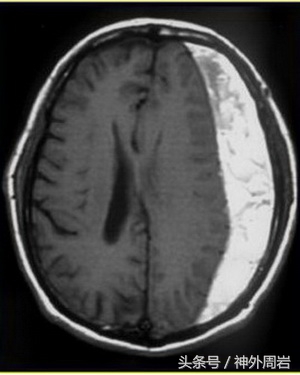 老人慢性硬膜下血肿严重吗,老年人慢性硬膜下血肿