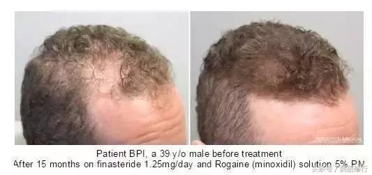 掉头发用防脱洗发水,掉头发买防脱洗发水有效没