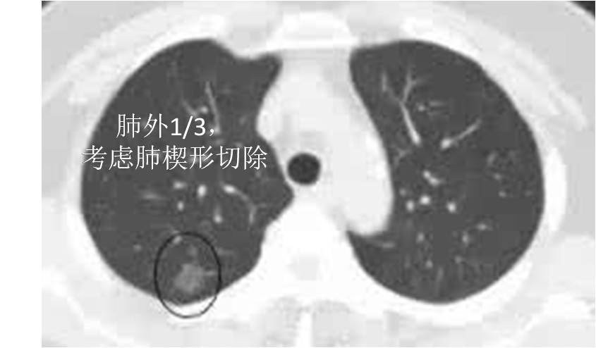 10mm磨玻璃密度结节早期肺癌手术,右肺上叶9mm磨玻璃结节需要手术吗