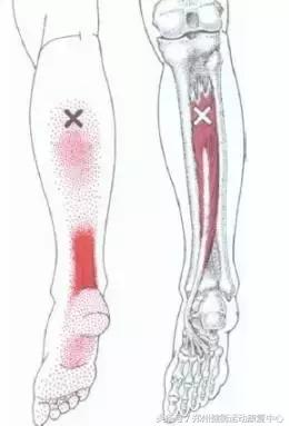 跟腱炎的治疗最好的方法,跟腱炎做什么运动恢复视频