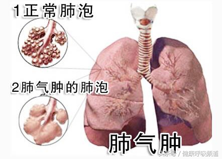 呼吸困难与气急气短区别,气短呼吸困难是什么原因