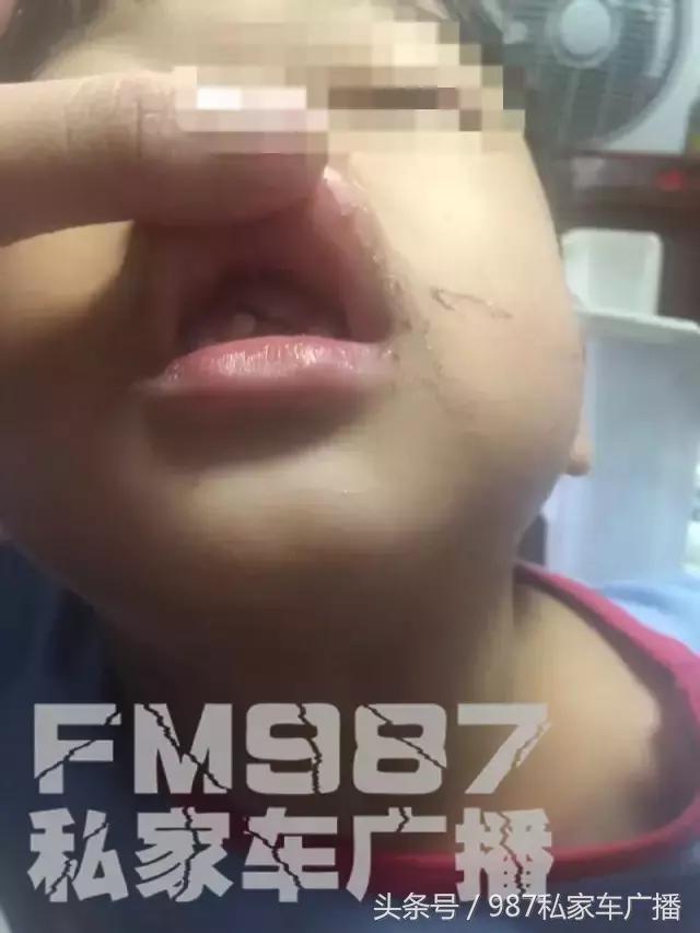 孩子门牙被撞了,小孩被撞门牙磕断对方家长不承认