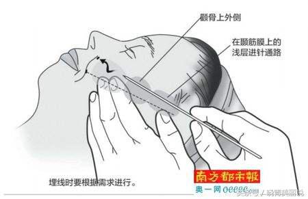 脸垮是先提拉还是填充,脸垮做什么医美没套路