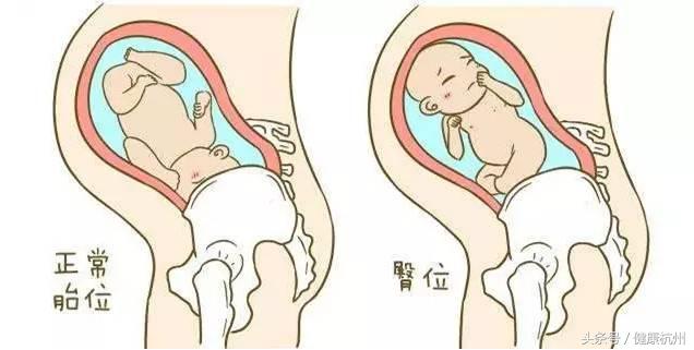 乾坤大挪移臀位手术,臀位头位乾坤大挪移