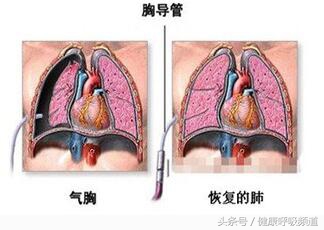 呼吸困难与气急气短区别,气短呼吸困难是什么原因