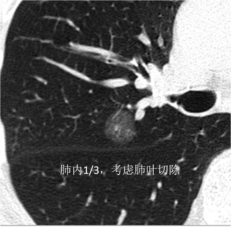 10mm磨玻璃密度结节早期肺癌手术,右肺上叶9mm磨玻璃结节需要手术吗