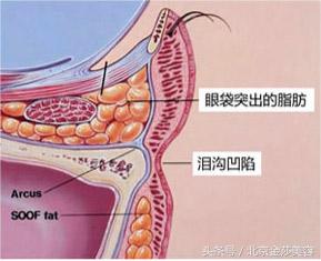 泪沟和眼袋有什么区别?预防及治疗方法有哪些?