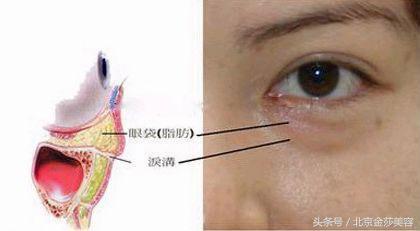 泪沟和眼袋有什么区别?预防及治疗方法有哪些?