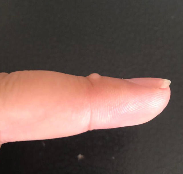 长在关节上的扁平的软软的疙瘩是啥病呢?