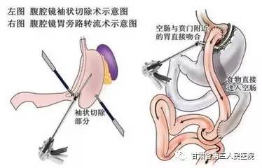 医院减肥糖尿病,合并2型糖尿病适合哪种减重手术