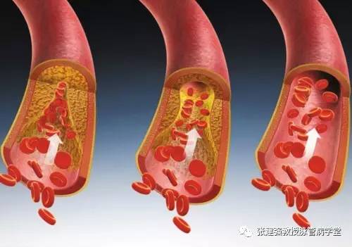 怎么让血管不长斑,消除血管斑的最佳方法