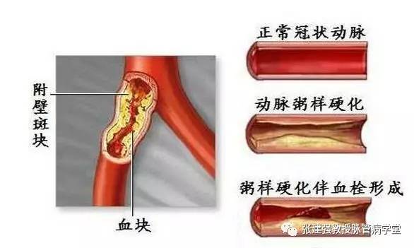 怎么让血管不长斑,消除血管斑的最佳方法