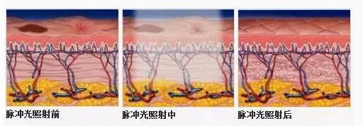 不神化的光子嫩肤,给皮肤反季节的吹弹可破!