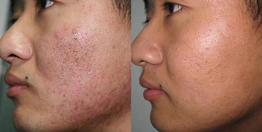 不神化的光子嫩肤,给皮肤反季节的吹弹可破!