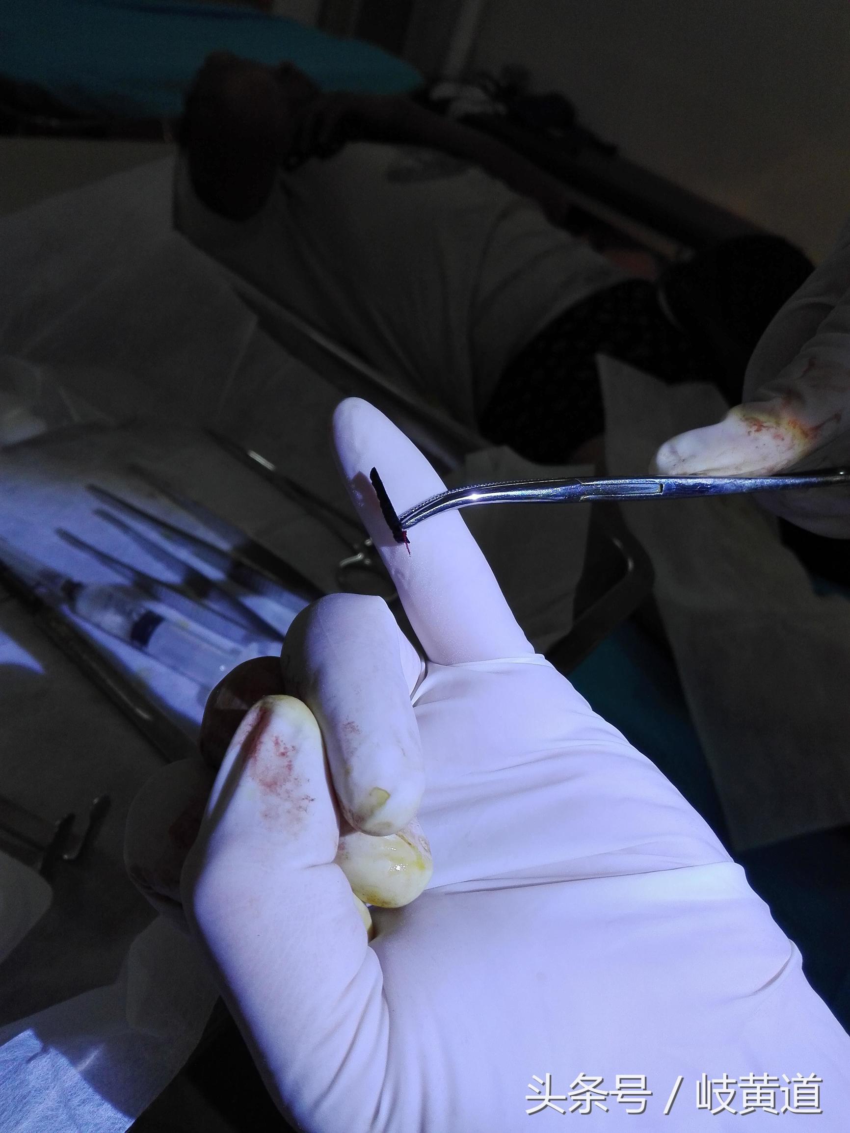 钢渣扎进男子大腿 医生手术2小时取出