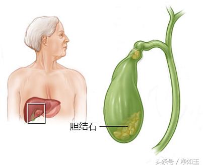 胆结石治疗方法和注意事项,胆结石正确治疗方法