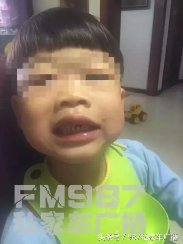 孩子门牙被撞了,小孩被撞门牙磕断对方家长不承认