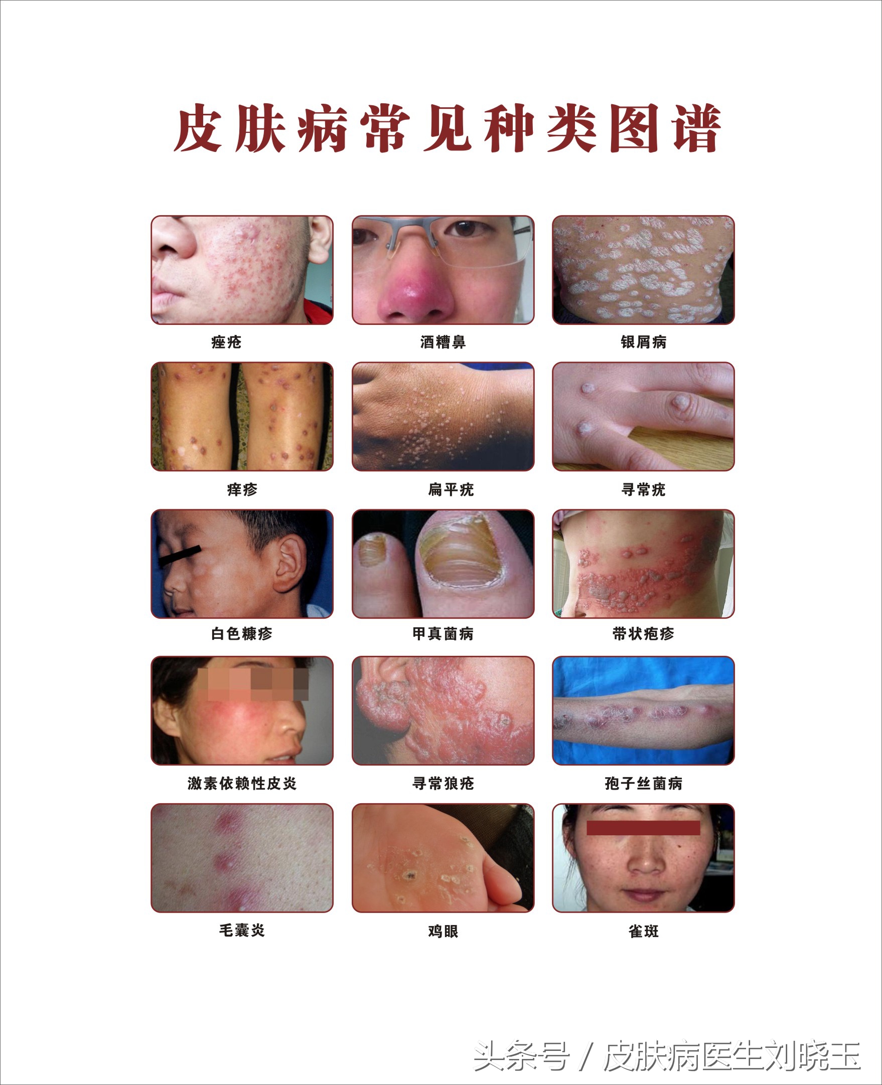 一般的白癜风白斑怎么治疗有效果,白癜风临床诊疗近40余年的专家