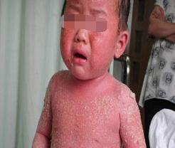 宝宝湿疹反反复复如何彻底根除,宝宝湿疹反反复复怎么根除