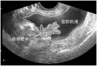 盆腔积水怎么回事,盆腔积液漏尿怎样治最好