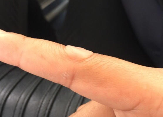 长在关节上的扁平的软软的疙瘩是啥病呢?