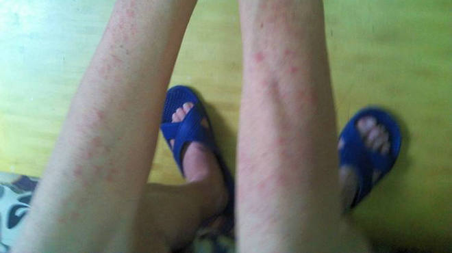 怎样食疗根治顽固性湿疹,食疗缓解湿疹在家就能做