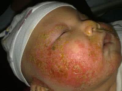 宝宝湿疹反反复复如何彻底根除,宝宝湿疹反反复复怎么根除