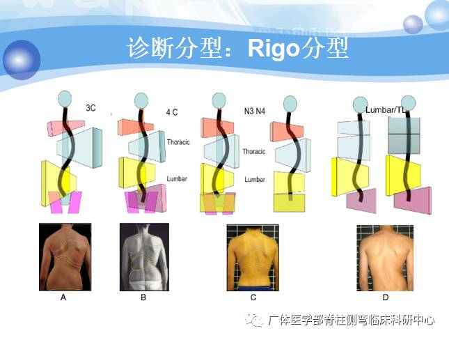 脊柱侧弯暑期训练营招募,脊柱侧弯夏令营视频