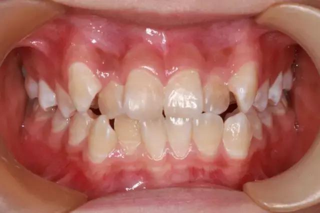 正畸戴牙环疼怎么办,正畸牙套戴不上了怎么办