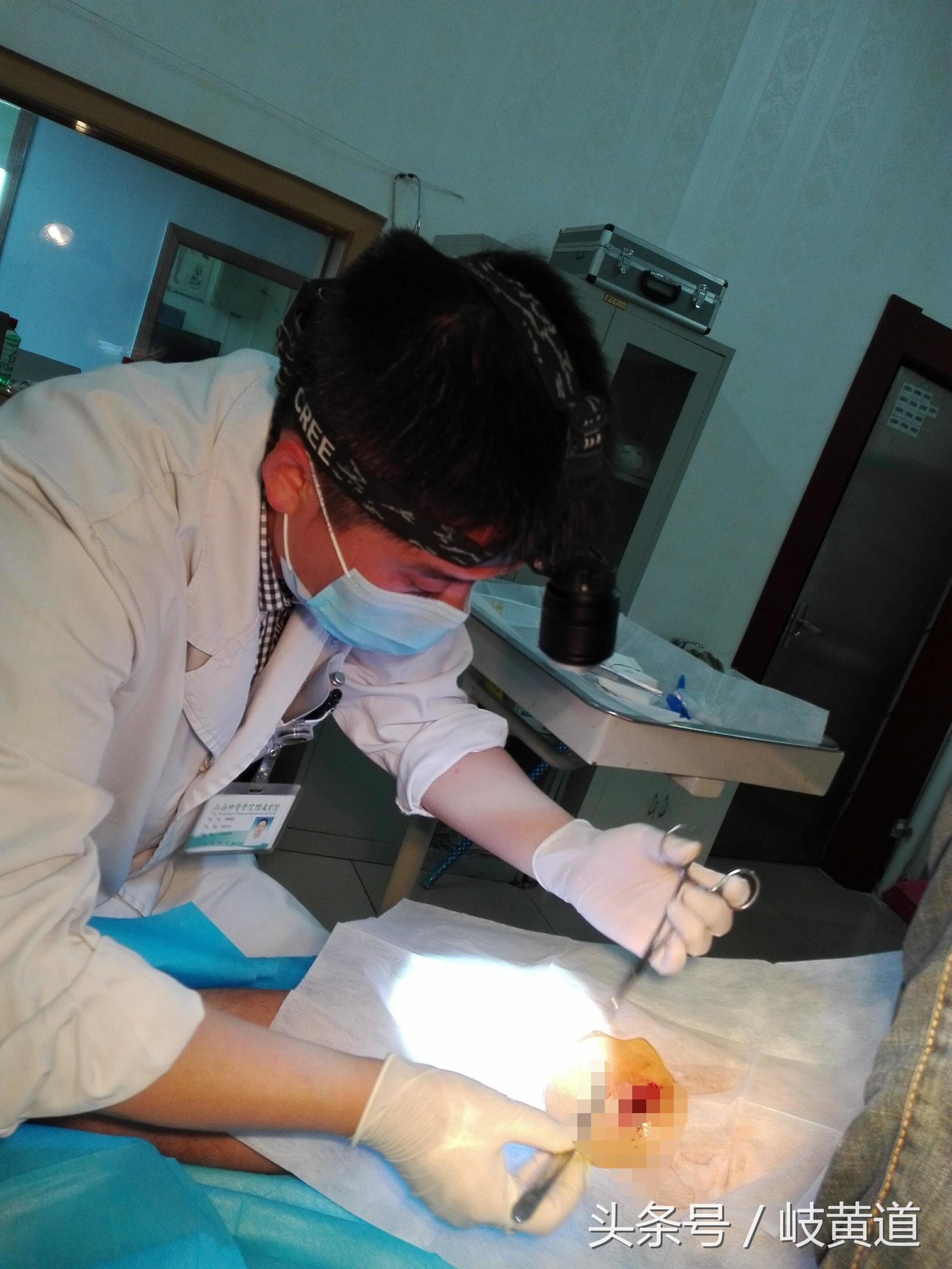钢渣扎进男子大腿 医生手术2小时取出