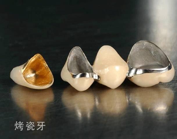 刘涛全瓷牙经验之谈,刘涛全牙美白