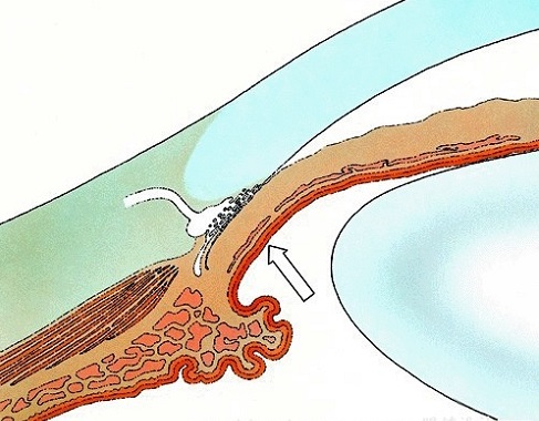 透析病人pth偏高血钙偏低,透析病人高钙血症怎么处理