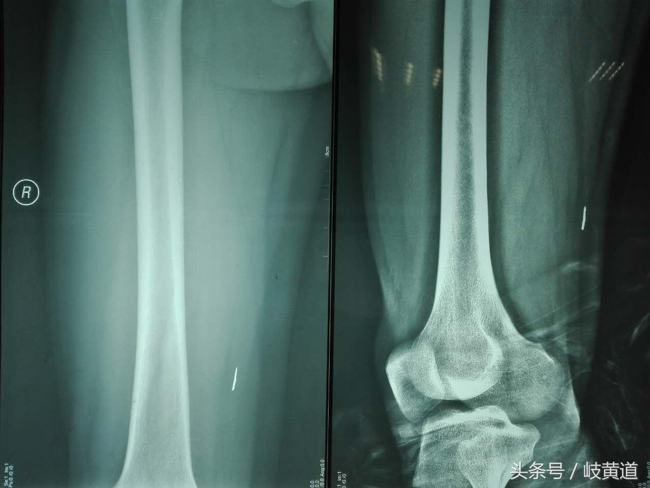 钢渣扎进男子大腿 医生手术2小时取出