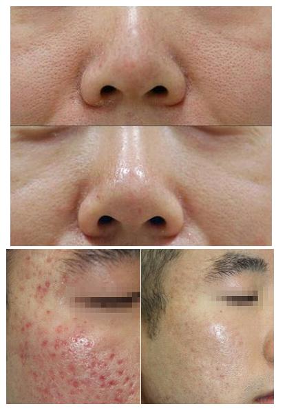 不神化的光子嫩肤,给皮肤反季节的吹弹可破!