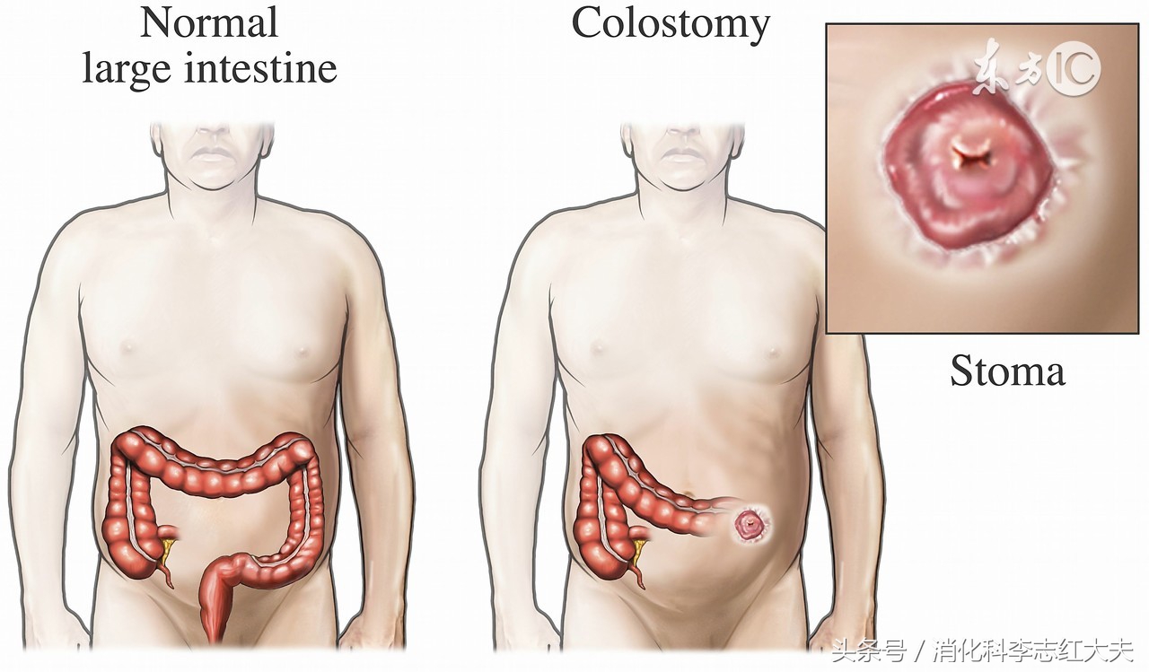 溃疡性结肠炎西药灌肠最好的方子,溃疡性结肠炎灌肠最好的中药方子