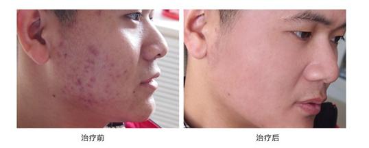 不神化的光子嫩肤,给皮肤反季节的吹弹可破!