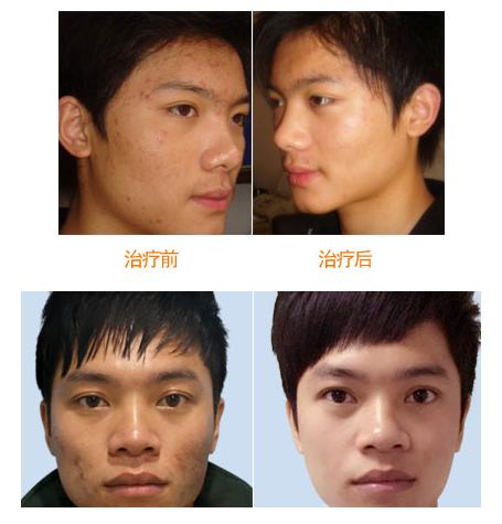 不神化的光子嫩肤,给皮肤反季节的吹弹可破!