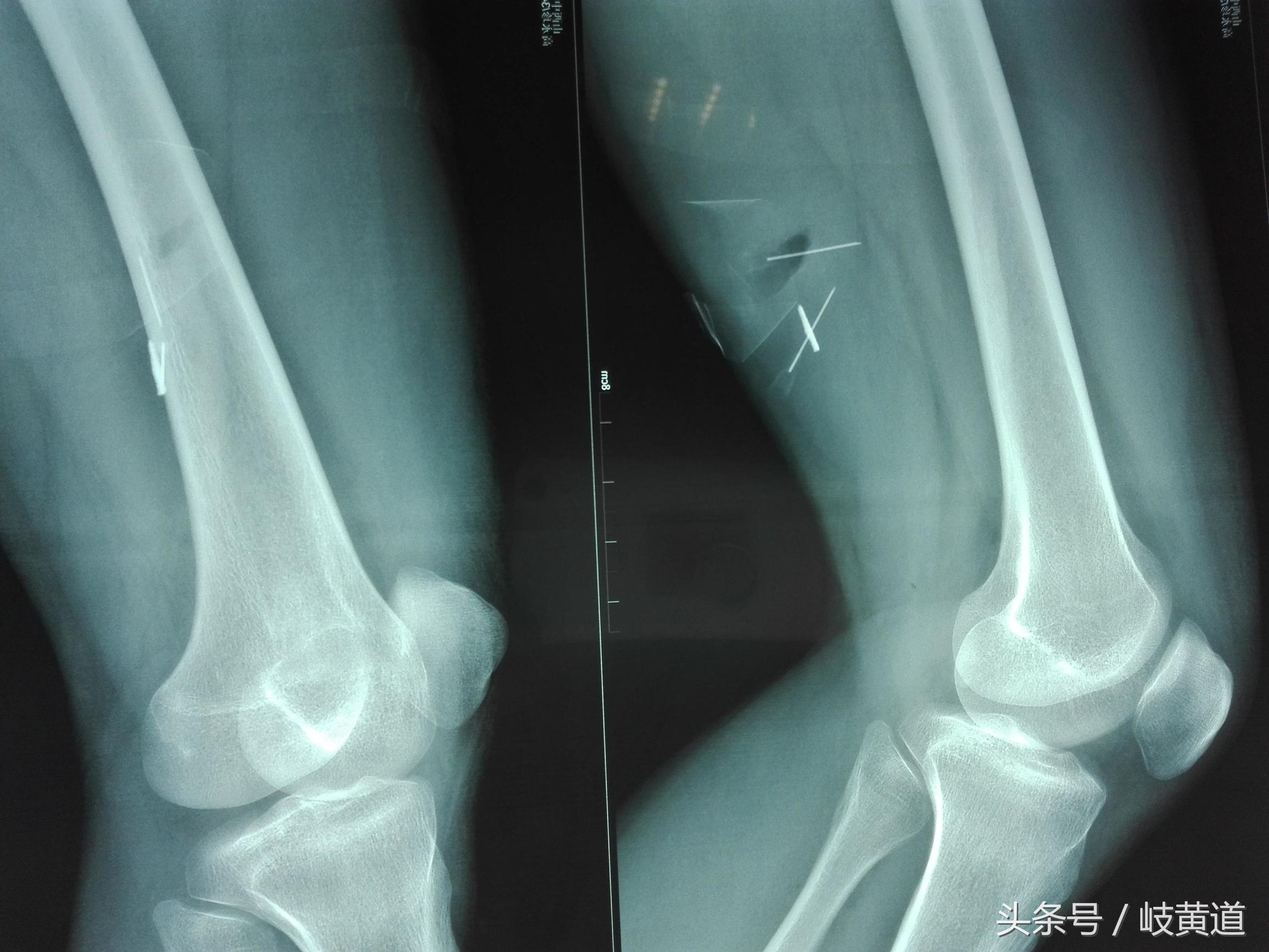 钢渣扎进男子大腿 医生手术2小时取出