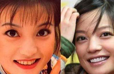 刘涛全瓷牙经验之谈,刘涛全牙美白